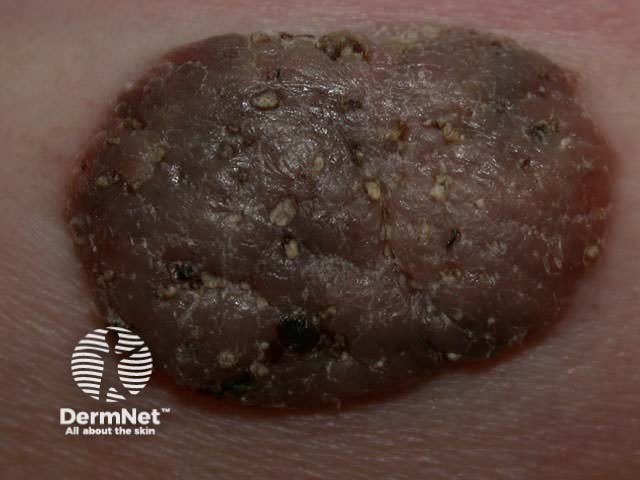 Seborrhoeic keratosis