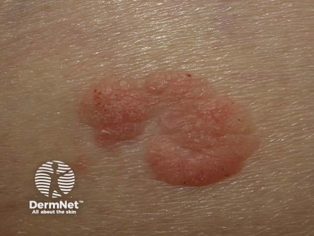 Seborrhoeic keratosis