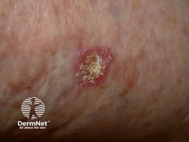 Inflamed actinic keratosis