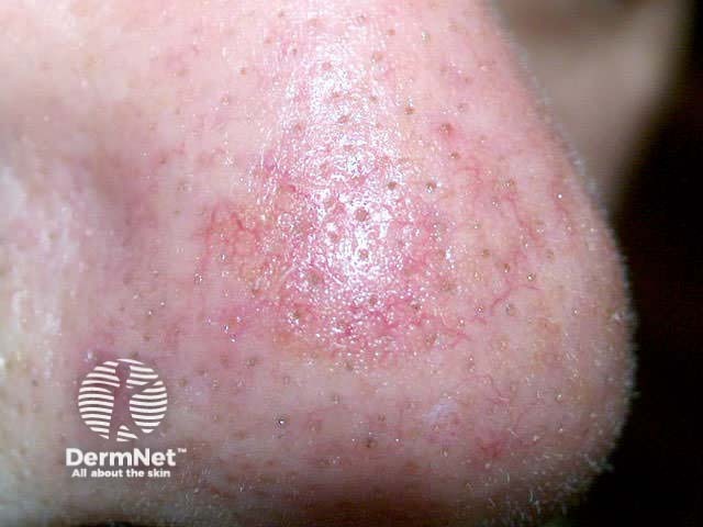 Non-scaly actinic keratosis