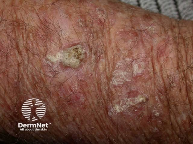 Hypertrophic actinic keratosis