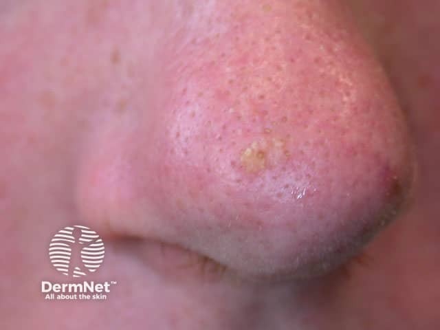 Solitary actinic keratosis