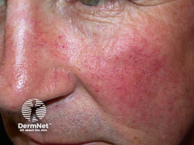 Rosacea