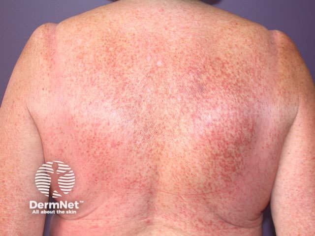 Telangiectasia eruptiva macularis perstans (mastocytosis)