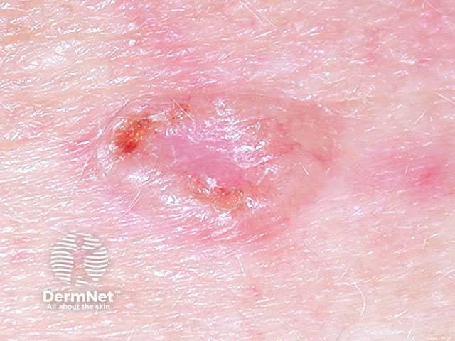 Basal cell carcinoma