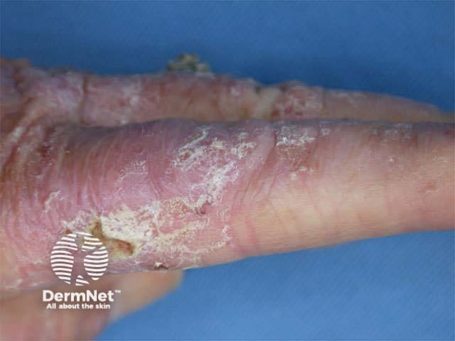 Actinic keratosis prior to treatment