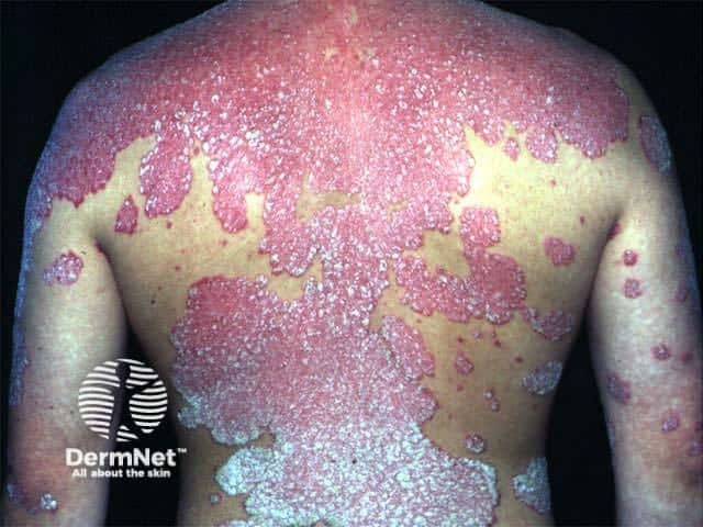 Psoriasis has extended in this patient with pre-existing disease after starting nivolumab