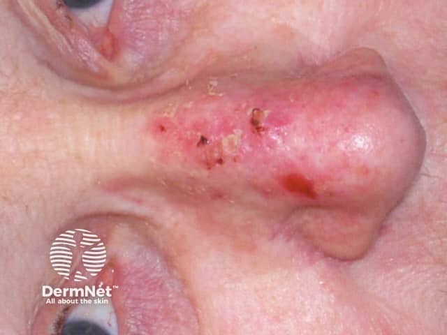 Actinic keratoses