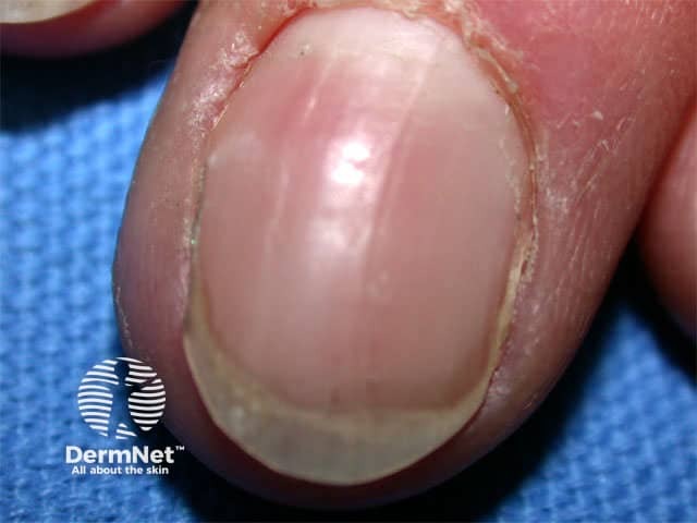 Resorption of distal phalanx