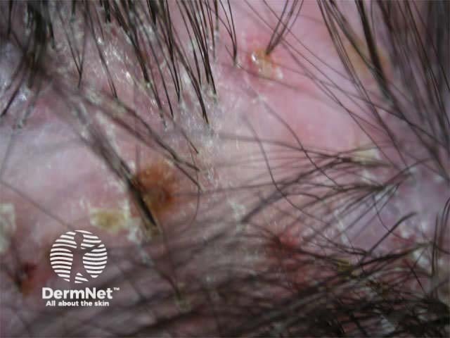 Tufted folliculitis