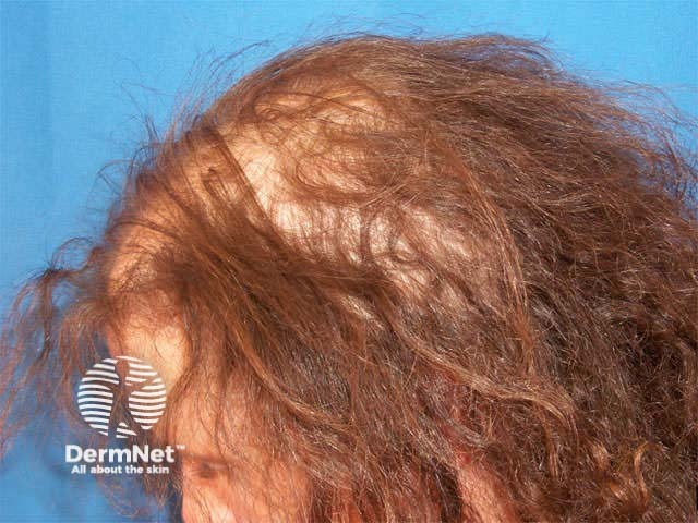 Diffuse alopecia areata