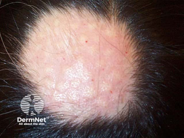 Localised alopecia areata