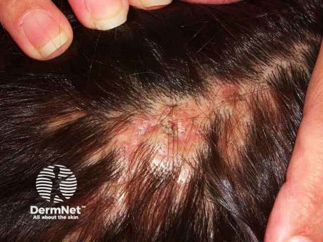 Scarring alopecia