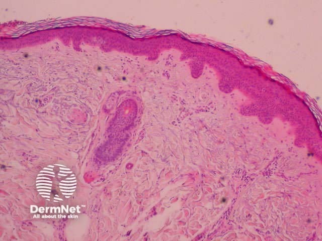 Haematoxylin and eosin stained