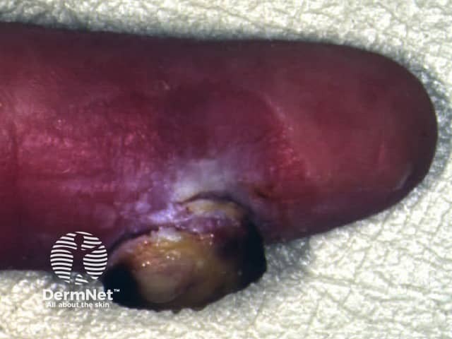 Periungual pyogenic granuloma