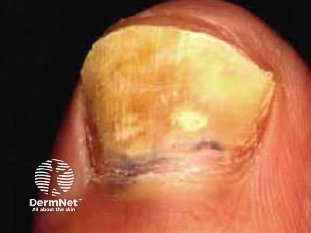 Fungal nail infection