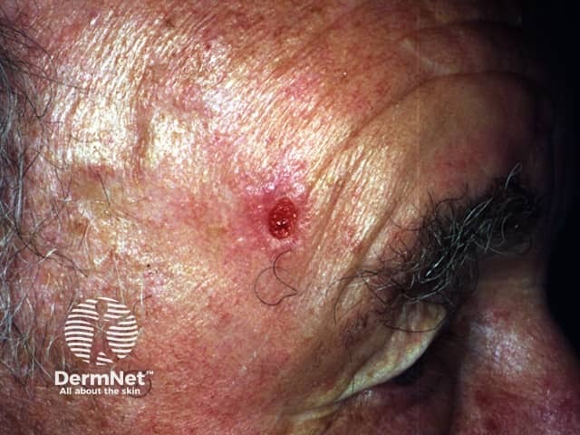 Basal cell carcinoma