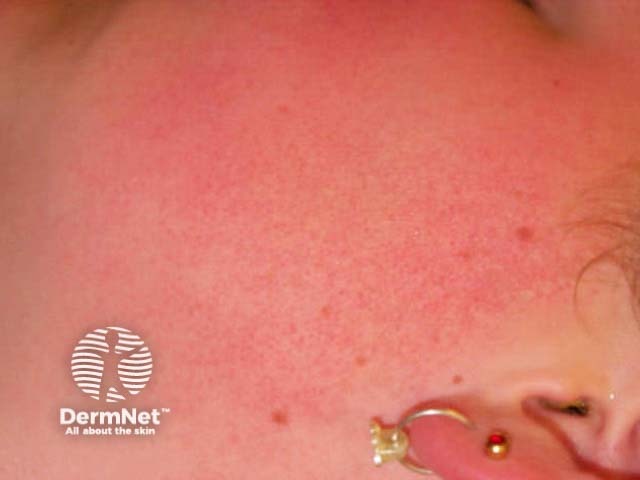 Keratosis pilaris faciei