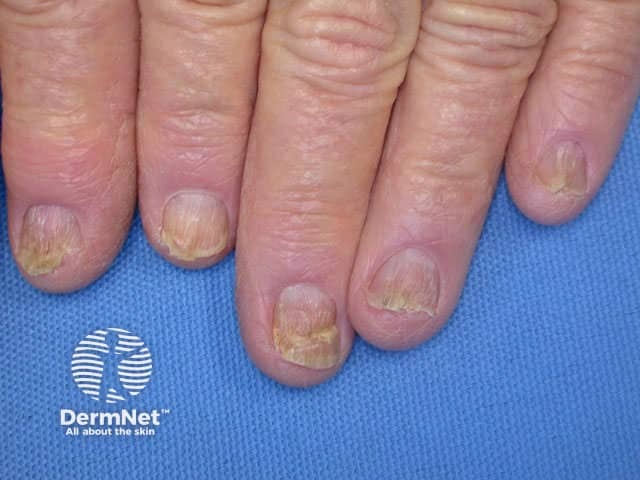 Nail dystrophy