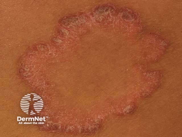 Annular psoriasis