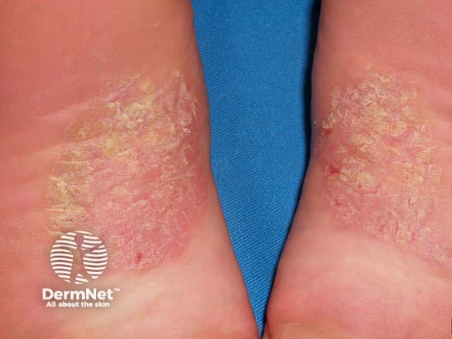 Chronic plaques of psoriasis