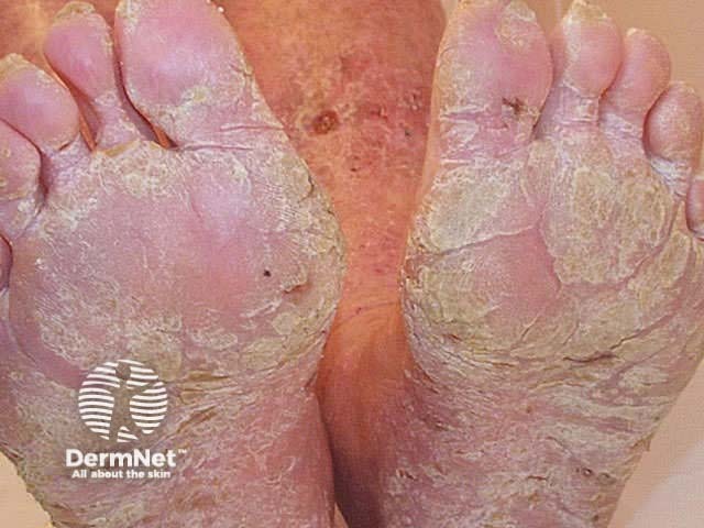 Keratoderma