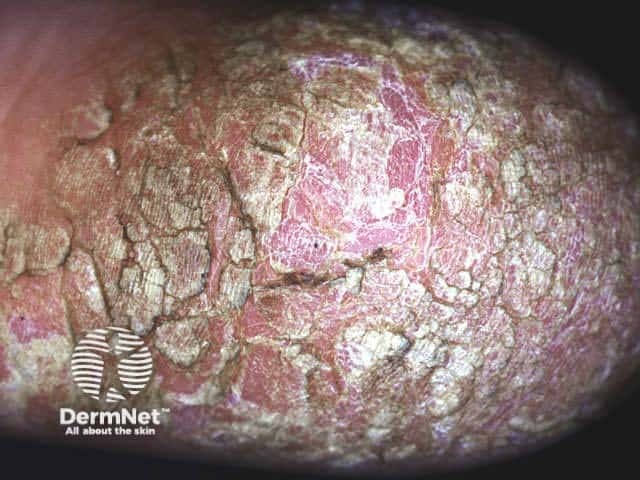 Chronic plaques of psoriasis