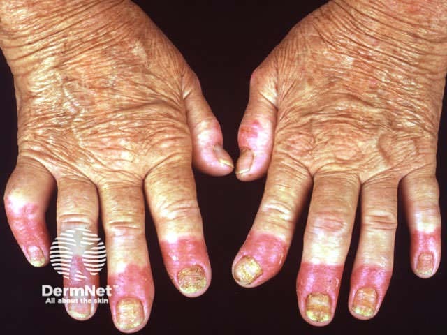 Acrodermatitis continua