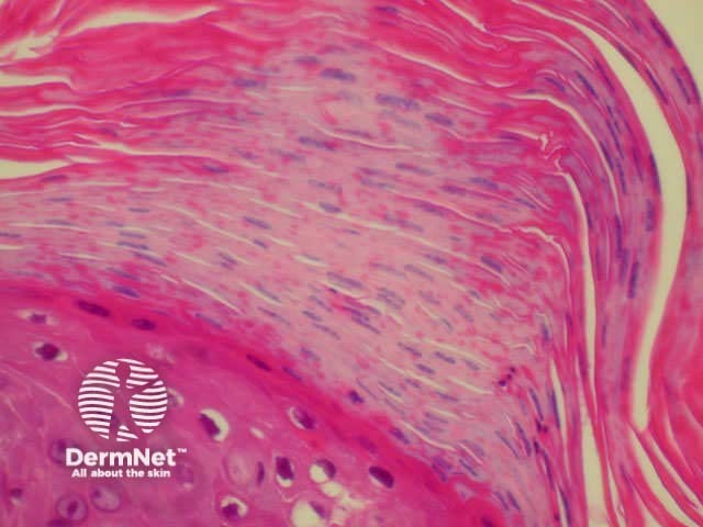 Parakeratosis (cell nuclei within thickened stratum corneum)