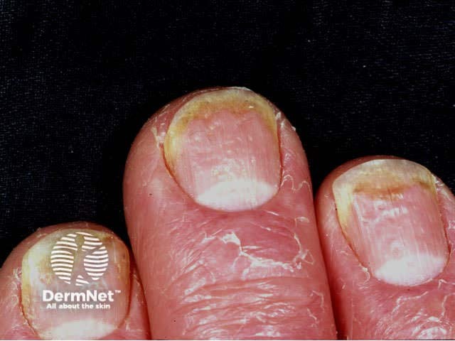 Nail psoriasis