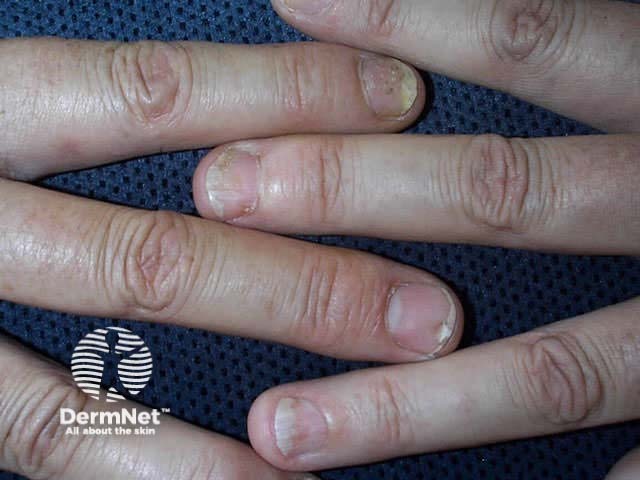 Nail psoriasis