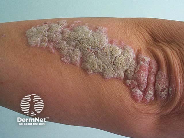 Ostraceous psoriasis