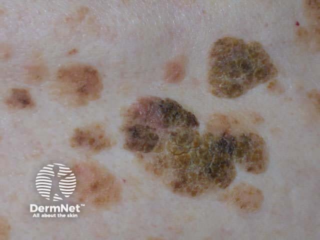 Sign of Leser Trelat: seborrhoeic keratoses