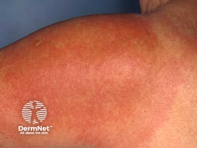 Erythema migrans