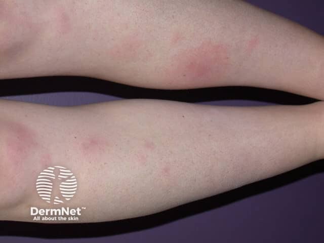 Erythema nodosum