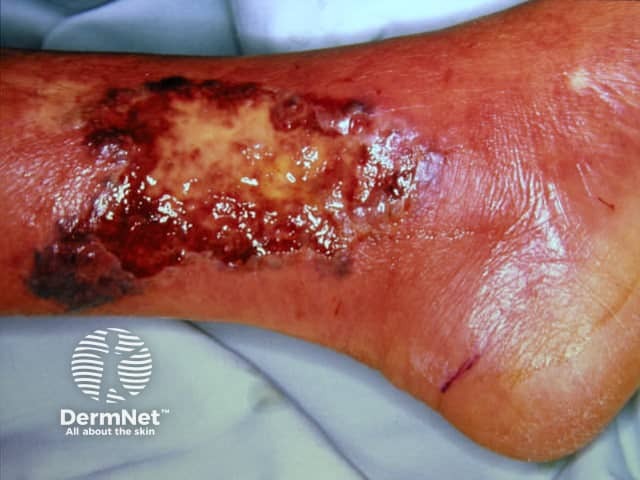 Pyoderma gangrenosum