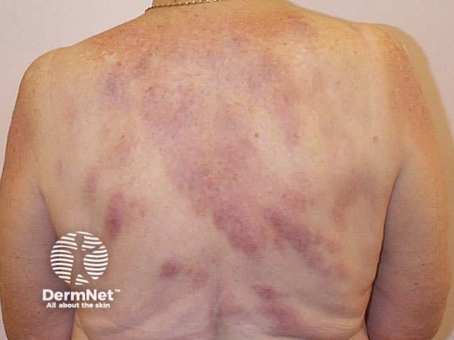 Extensive cutaneous sarcoidosis