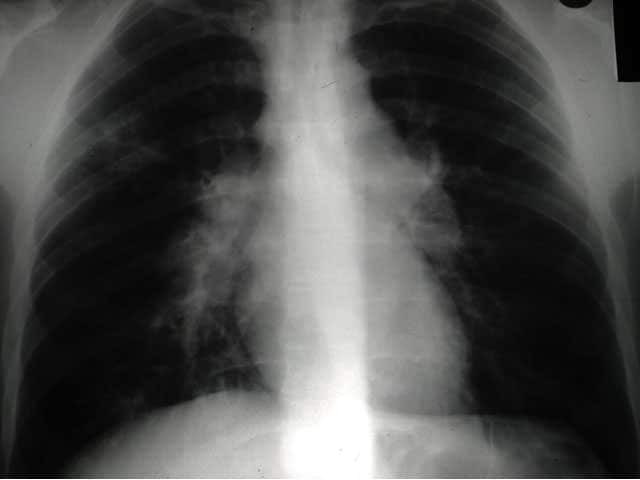 Bihilar lymphadenopathy in sarcoidosis