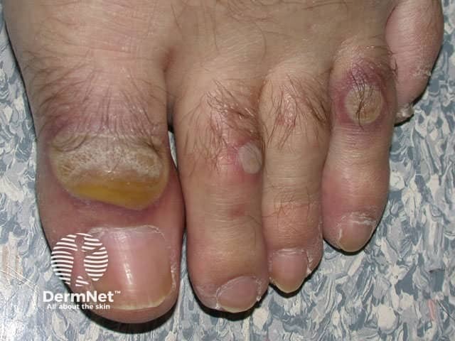 Erythema multiforme major