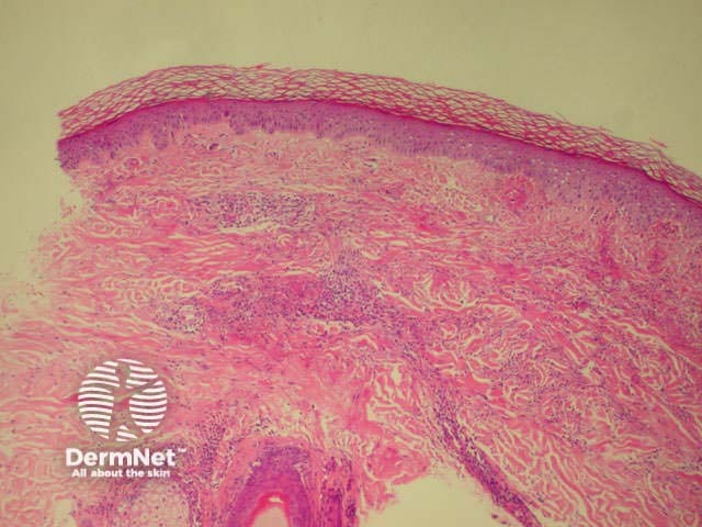 Dermatopathology of hypersensitivity vasculitis