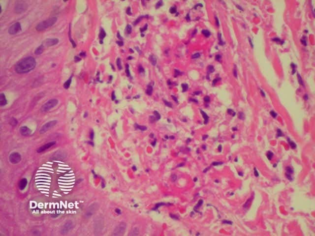 Dermatopathology of hypersensitivity vasculitis