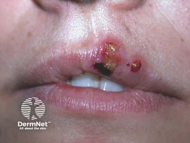 Recurrent herpes labialis