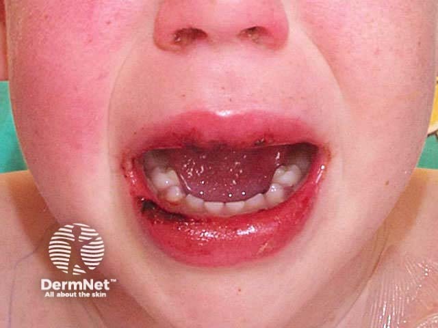 Kawasaki disease