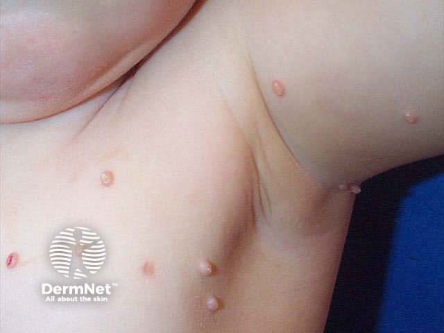 Molluscum contagiosum