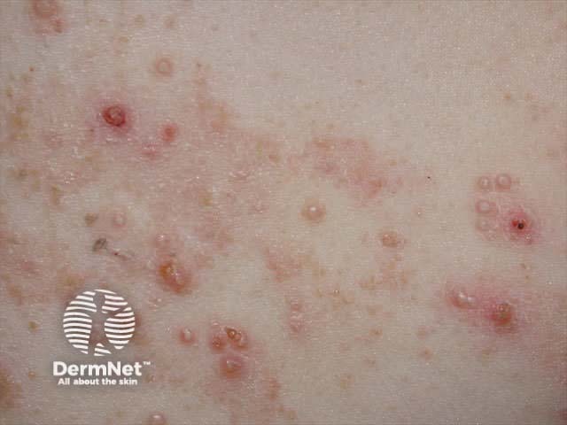 Molluscum contagiosum