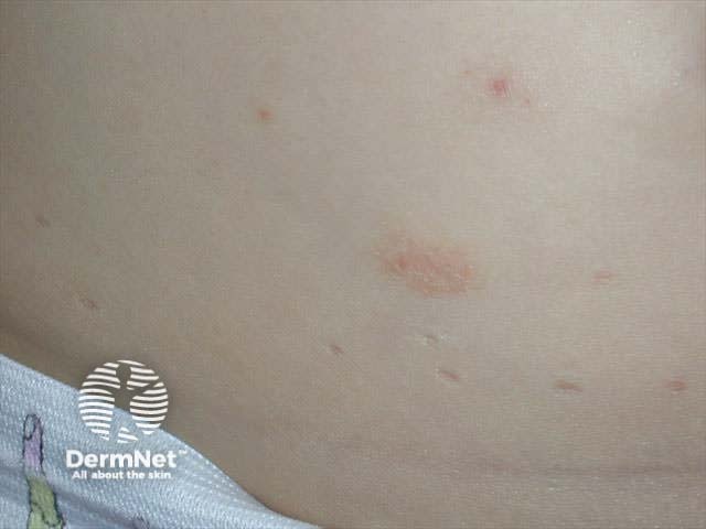 Molluscum contagiosum