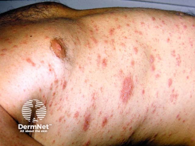 Extensive pityriasis rosea