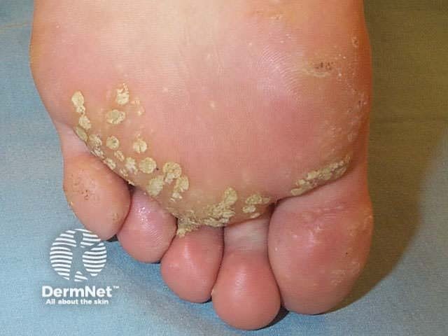 Salicylic acid treatment for warts