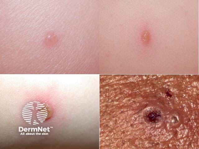 Lesions at differing stages