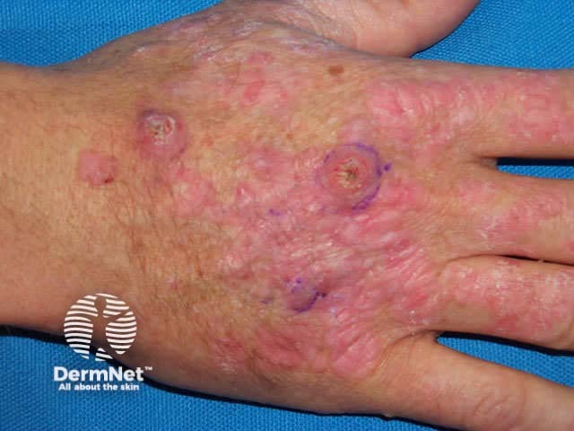 Warts, actinic keratoses and squamous cell carcinomas in a transplant patient